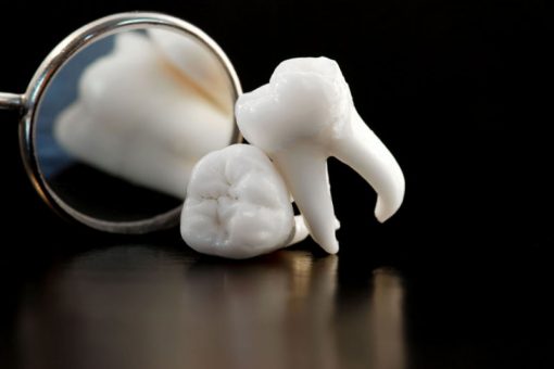 Dealing with Badly Stained Teeth: What Treatment Options Do You Have?