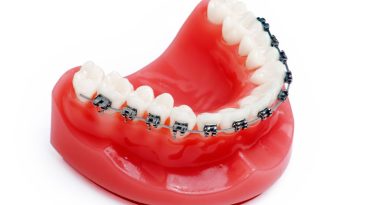Who Can Benefit from Orthodontics in Chanhassen, MN?